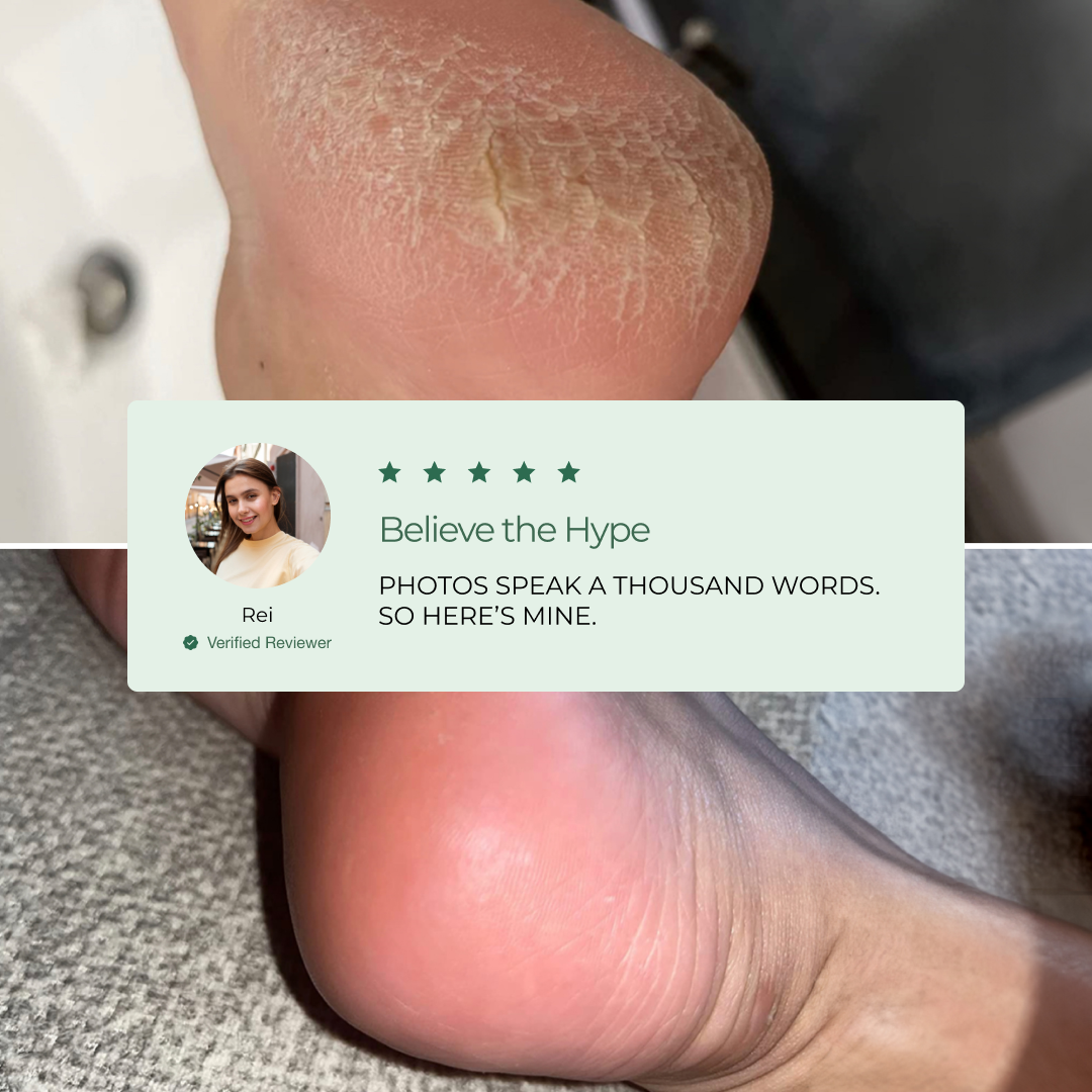 Customer Results with the Plantifique Foot Peel Mask