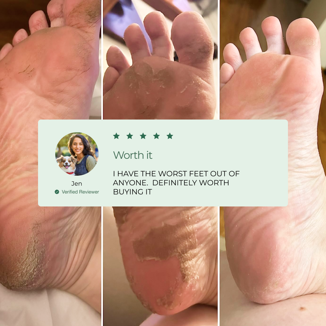 Customer Results with the Plantifique Foot Peel Mask