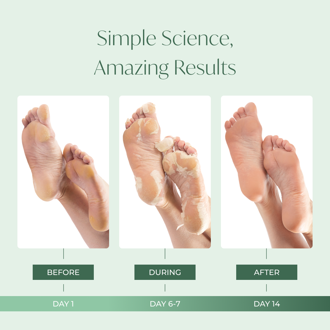 Results after using the Plantifique Foot Peel Mask